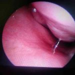 Deviated-nasal-septum-THUMB