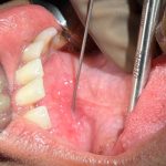 Sialendoscopy initial steps