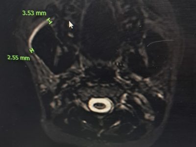 MR Sialogram and CT scan for Sialendoscopy