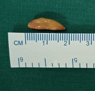 Removed Submandibular stones