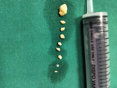 Removed stones parotid